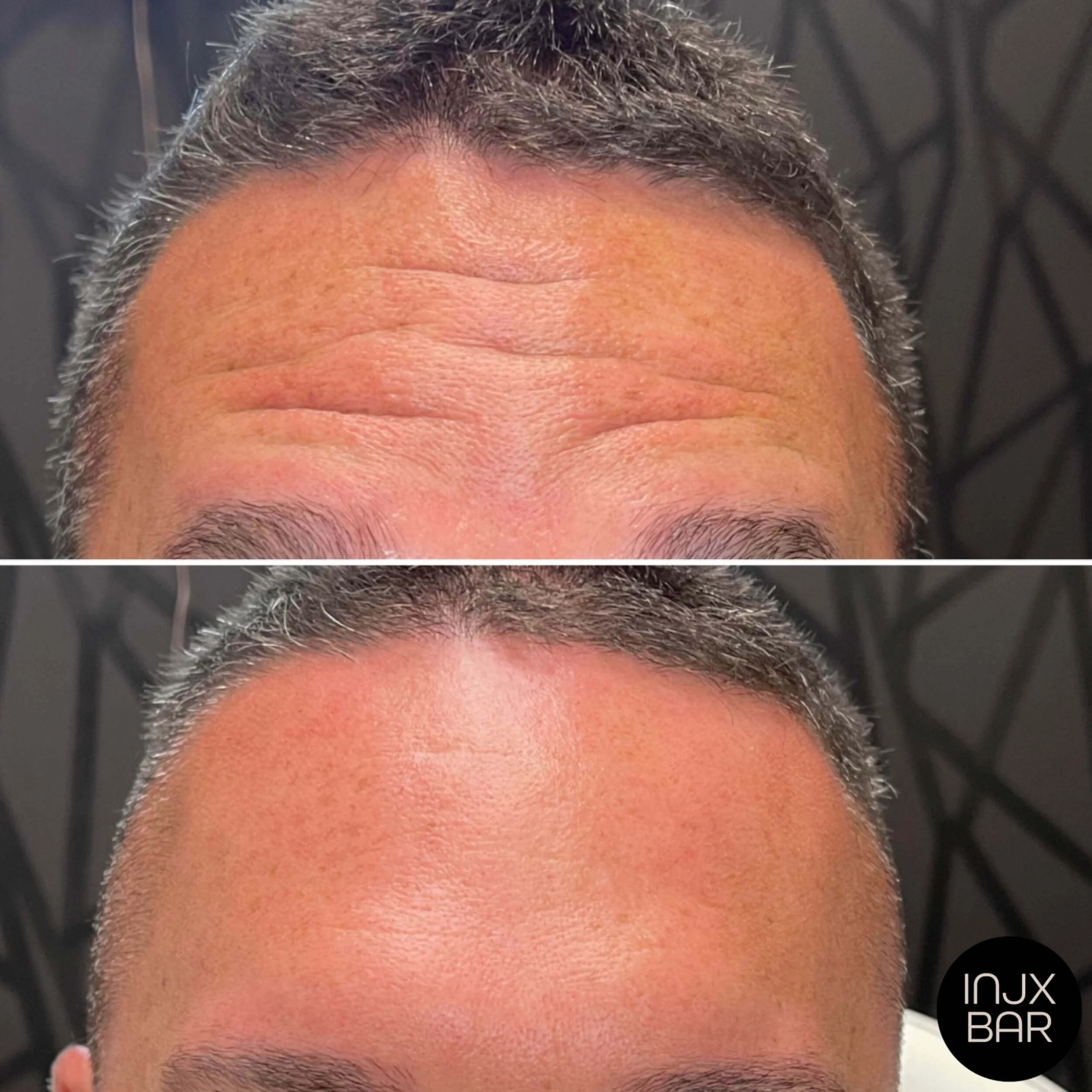  Before and 2 weeks after Xeomin treatment  for forehead lines. 