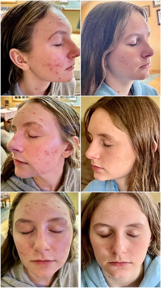 omnilux-clear-before-after-2.jpg
