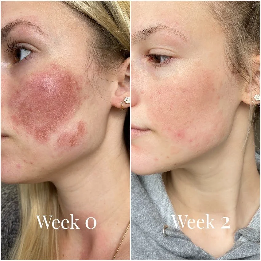 before-after-omnilux-contour.jpg