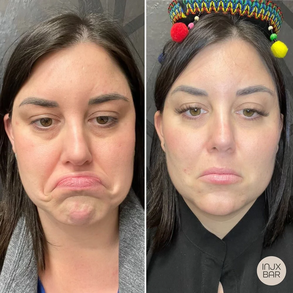before-and-after-botox-injx-bar.jpg