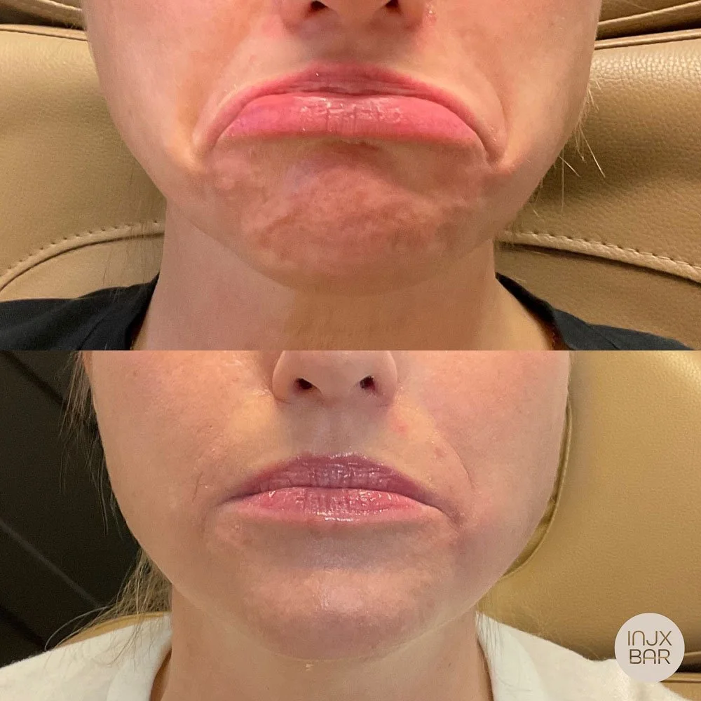 botox-for-jowls.jpg