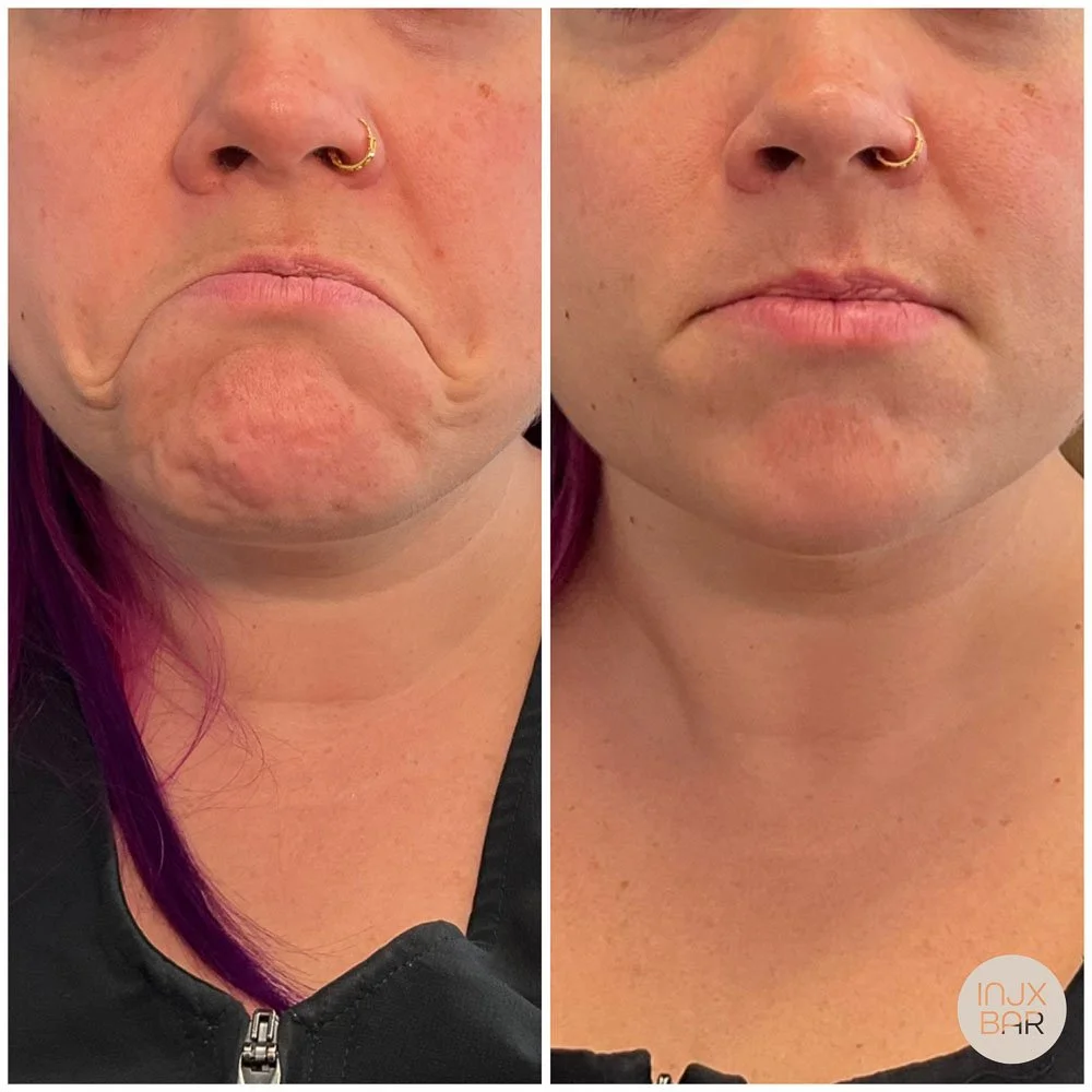 chin-botox.jpg