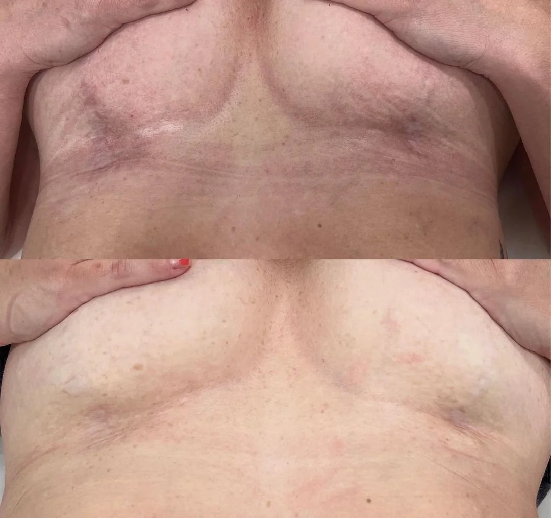  Laser treatment in Peoria, AZ for scar tissue.  