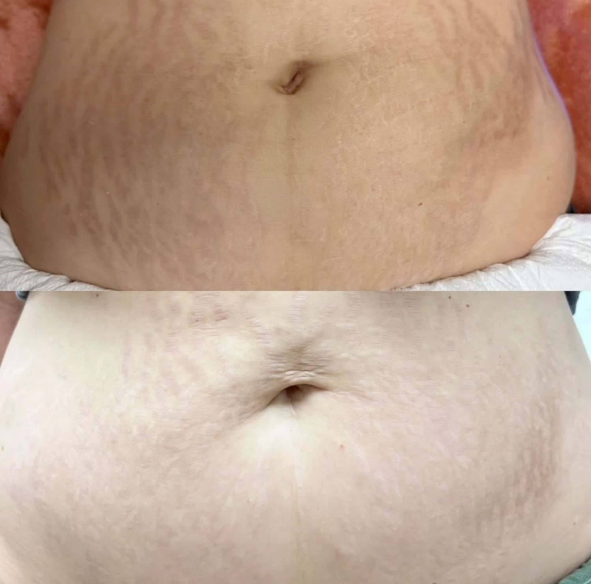  Laser treatment in Peoria, AZ for stretch marks. 