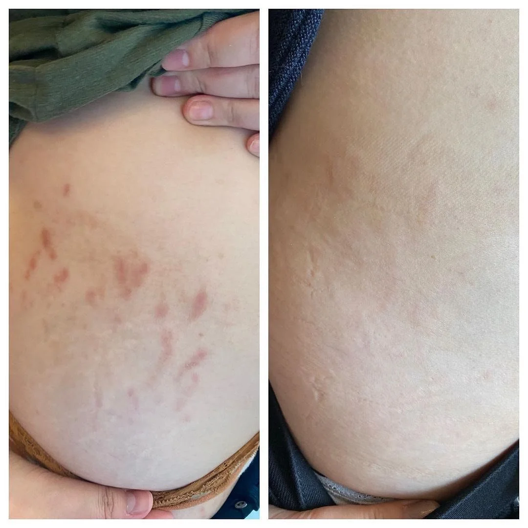  Laser treatment in Peoria, AZ for pregnancy stretch marks.  