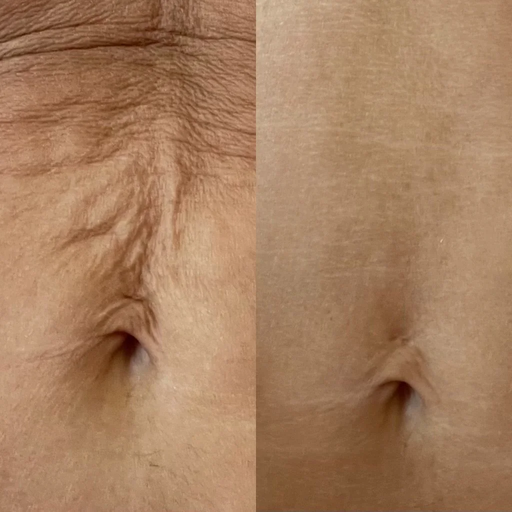 Laser treatment near Phoenix in Peoria, AZ scar tissue. 