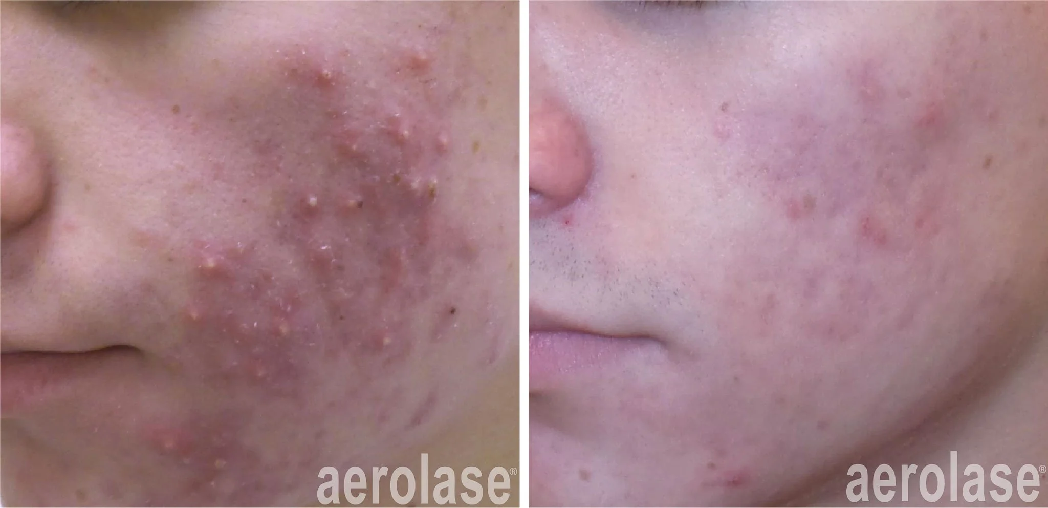  Before and after laser treatment for acne in Peoria, AZ. 