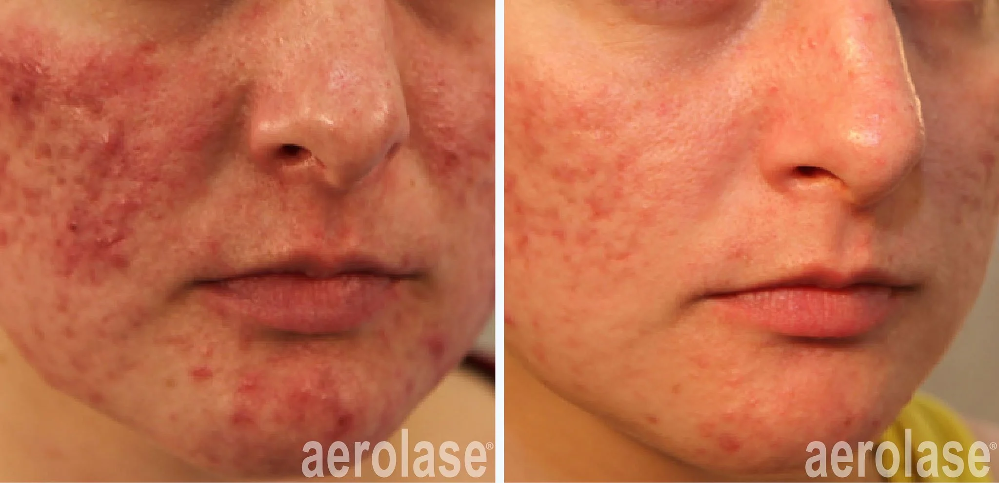  Before and after Aerolase clear treatment for acne scars.  