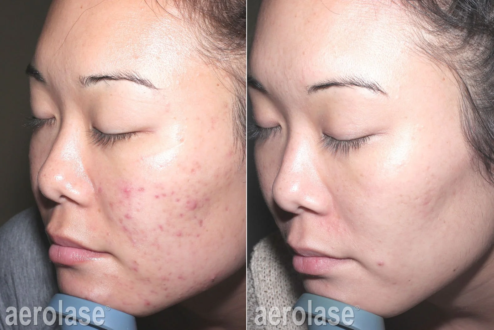  Before and after laser treatment for acne.  