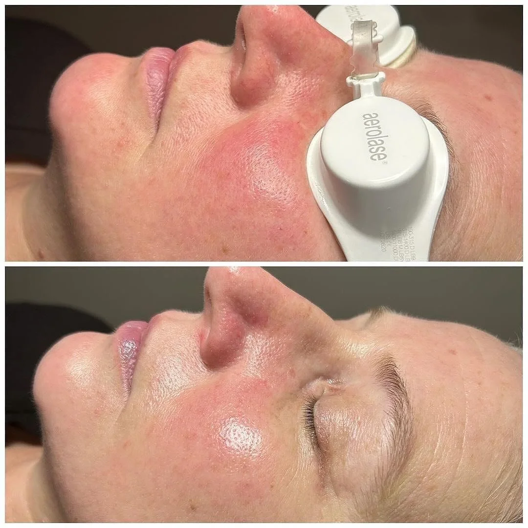 Before and after laser treatment for rosacea. 