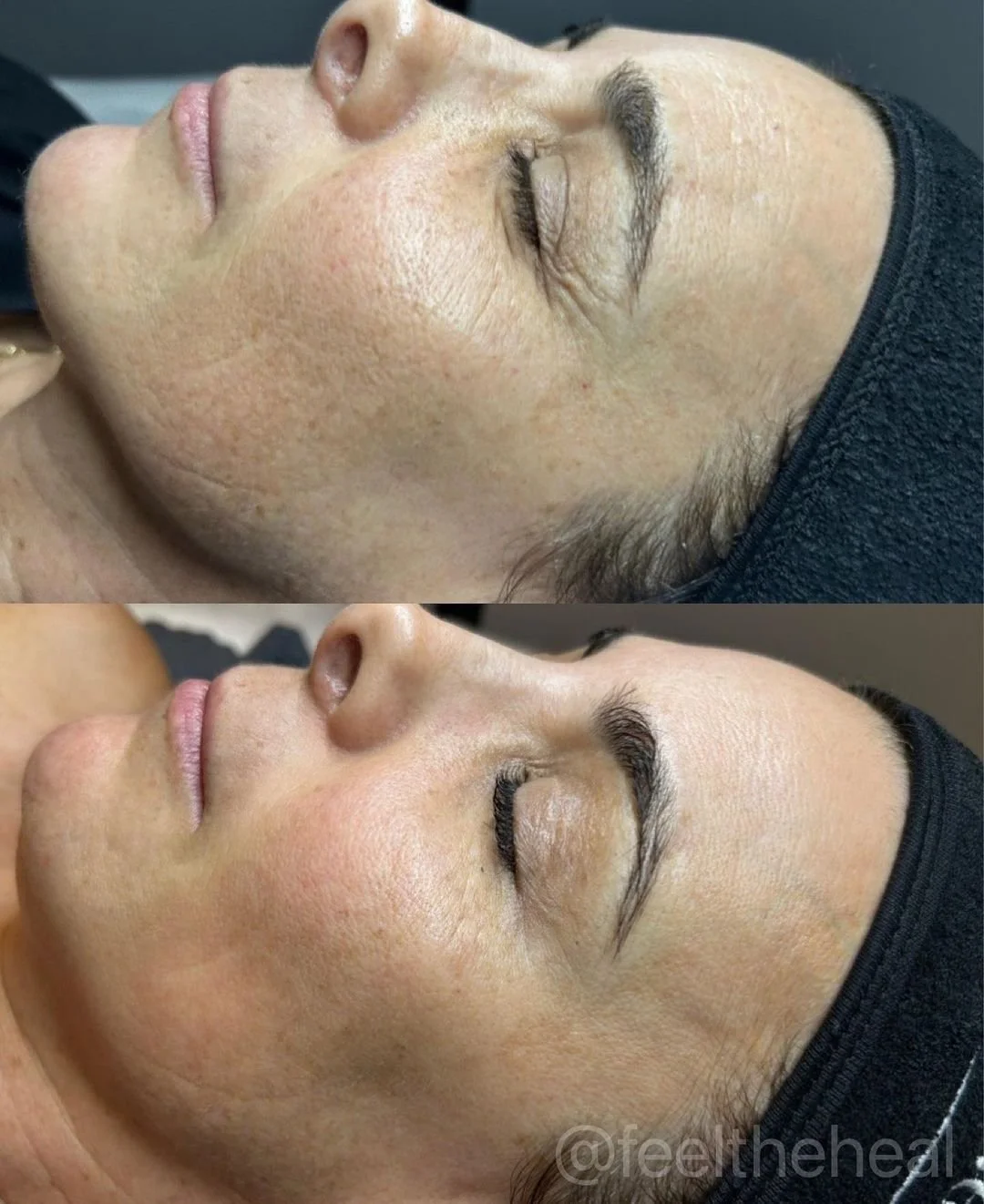  Before and after laser treatment for aging. 