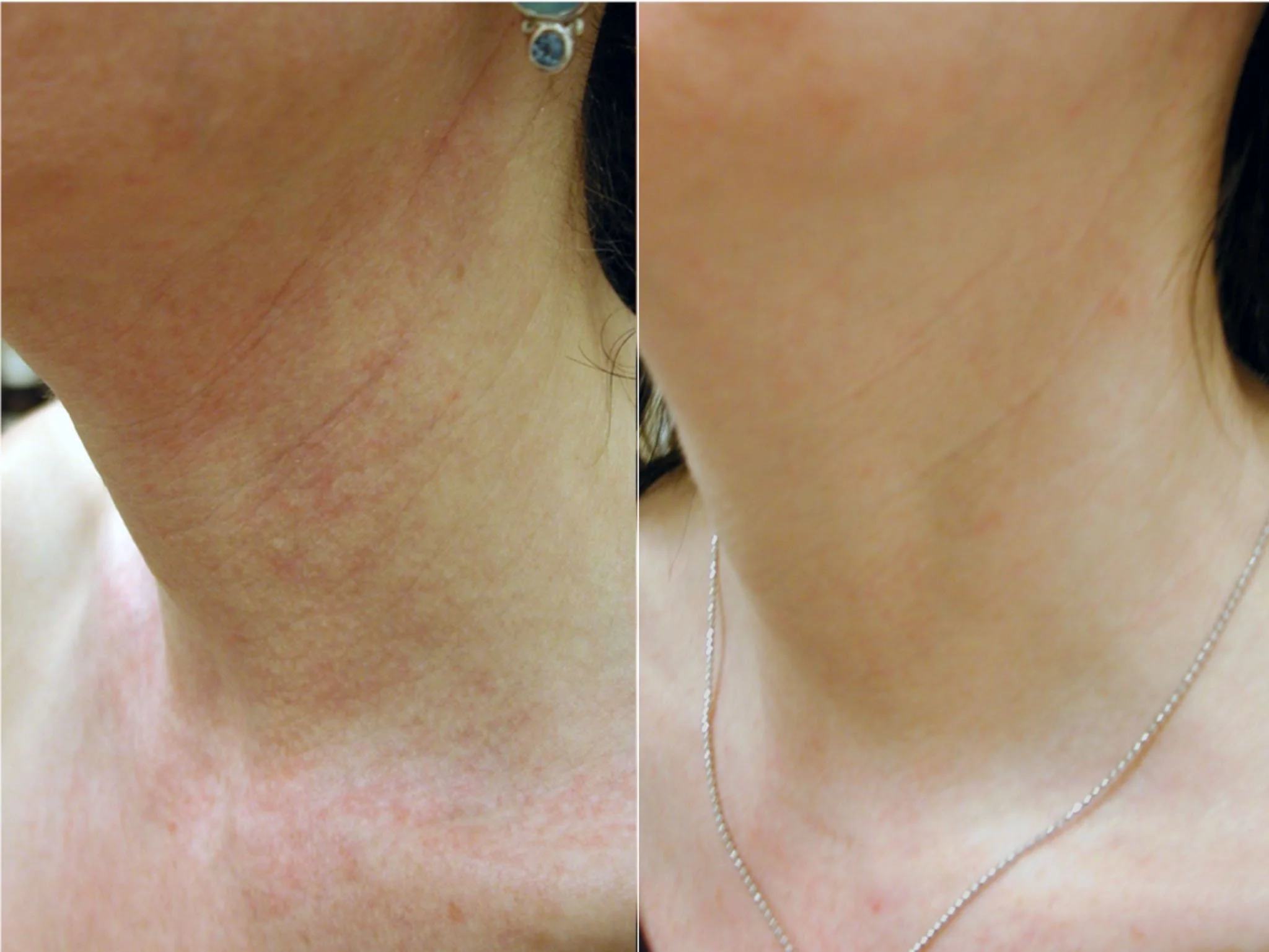  Before and after laser treatment for hyperpigmination in Peoria, AZ. 