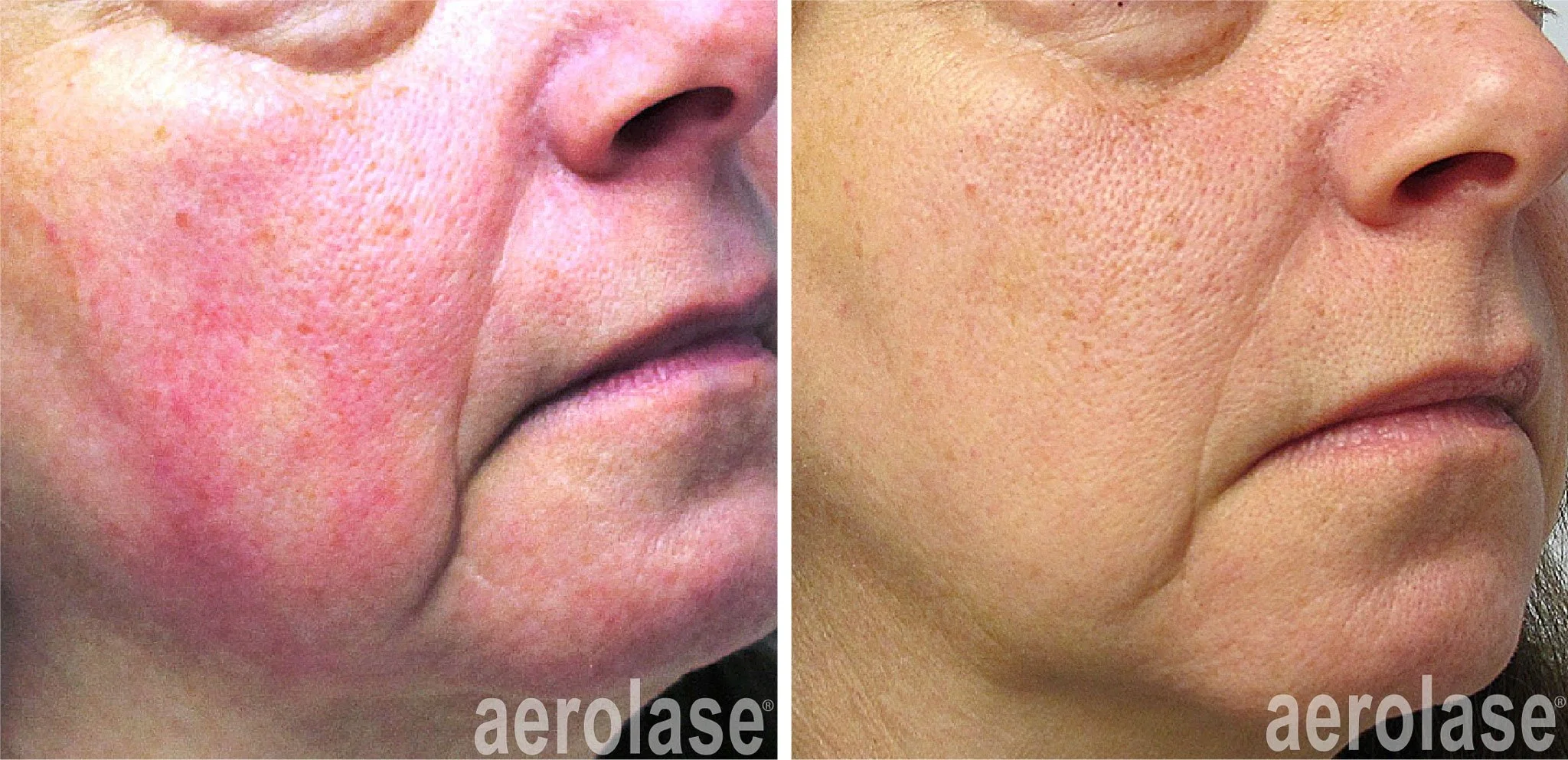  Before and after laswer treatment for rosacea. 