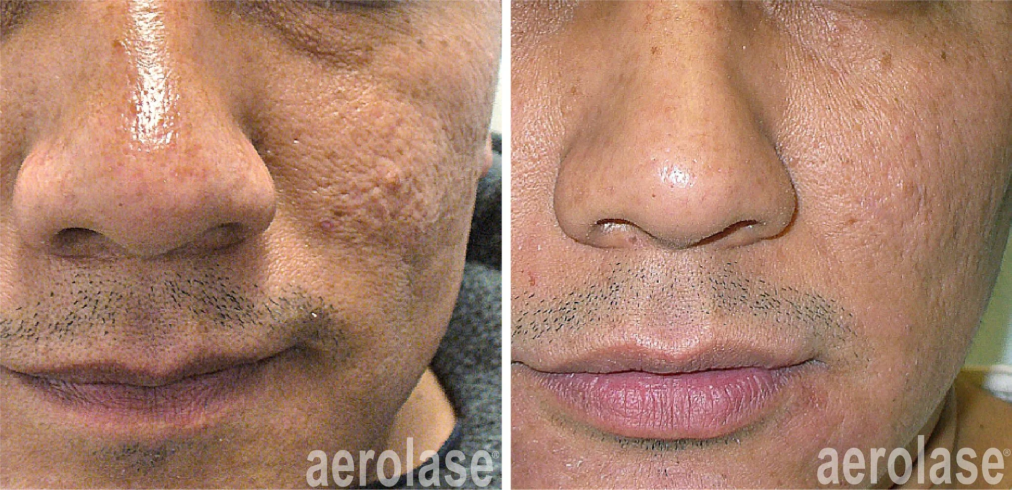  Before and after laser treatment for facial scars.  