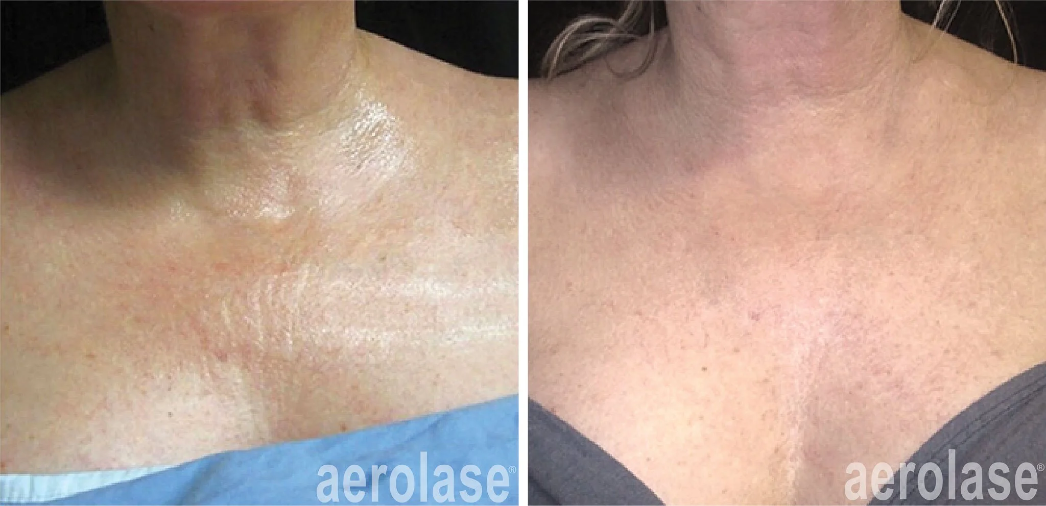  Before and after of laser treatment on neck and check to treat aging.  