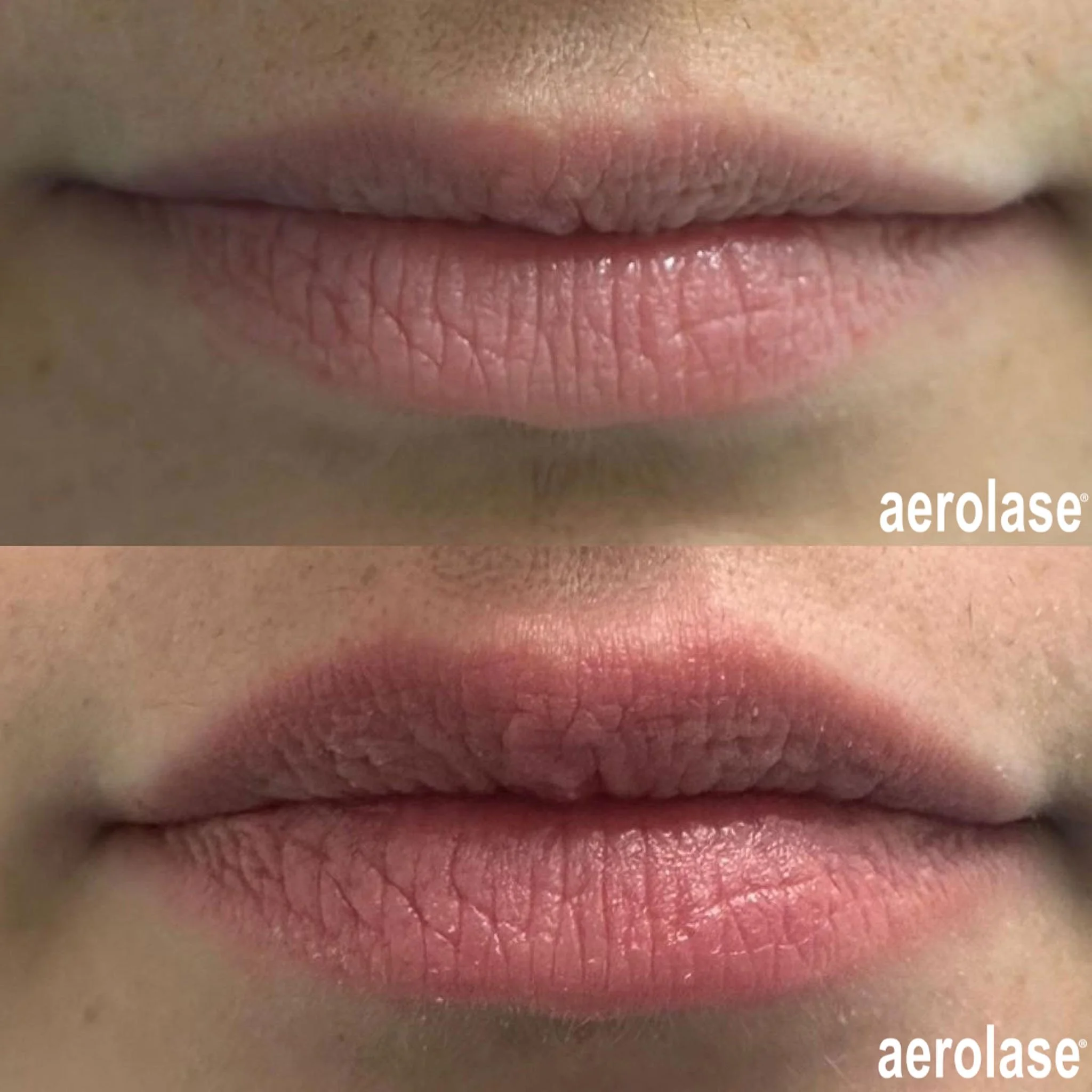  Before and after laser treatment for lip rejuventation in Peoria, AZ.  