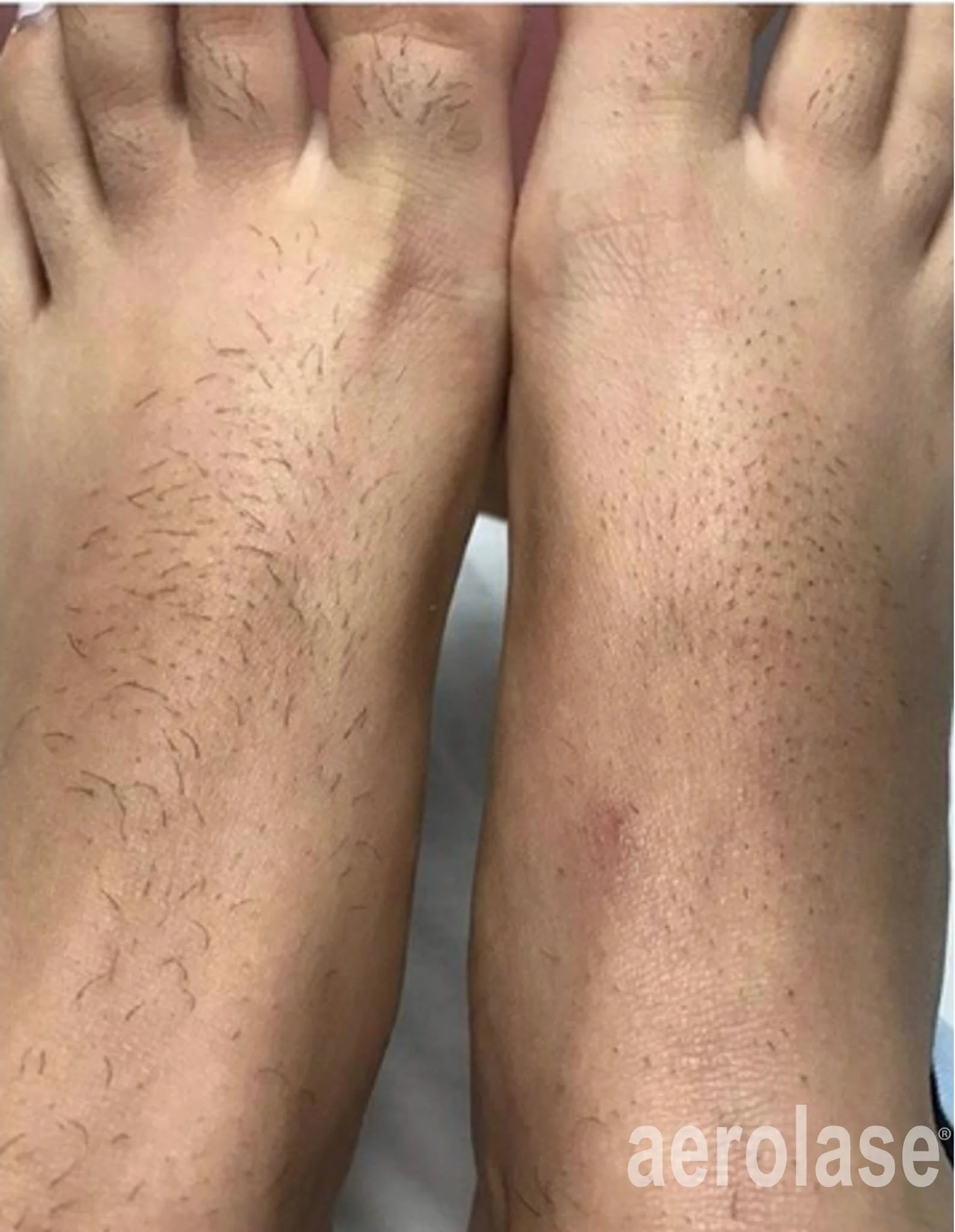  Laser hair removal for feet in Peoria,AZ. 