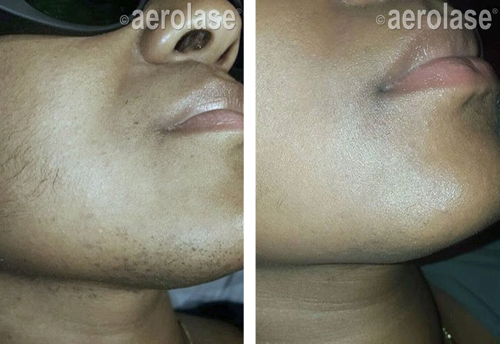  Laser hair removal near Phoenix in Peoria,AZ. 