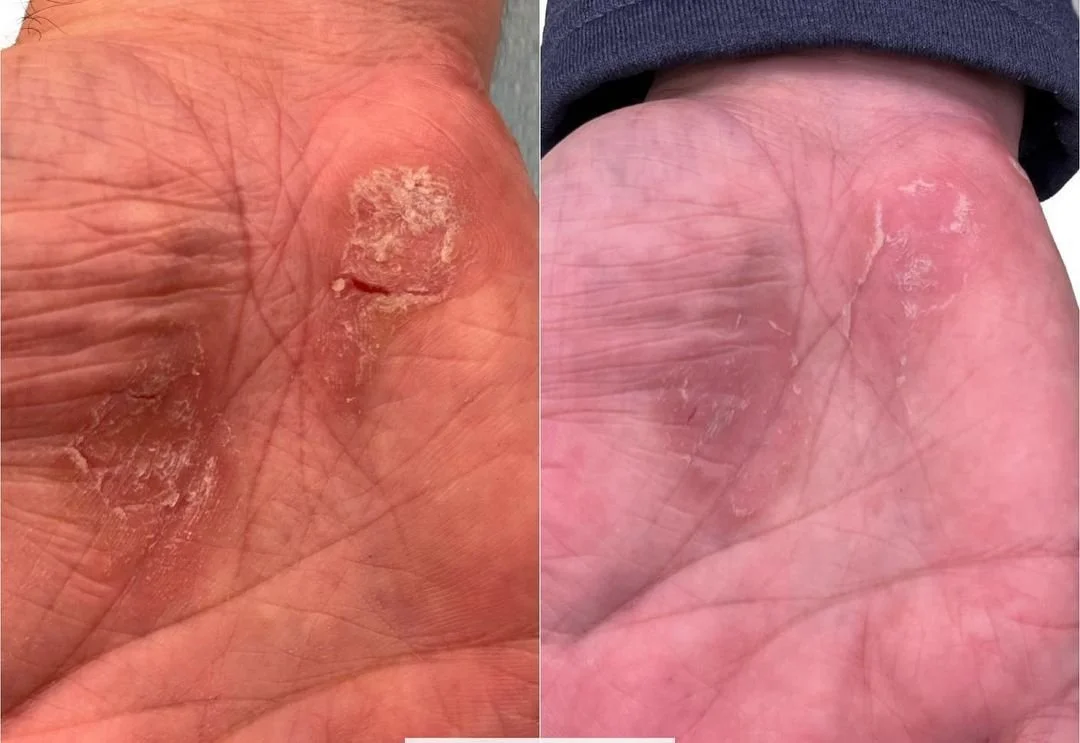  Before and after laser treatment for psoriasis on palm of hand.  