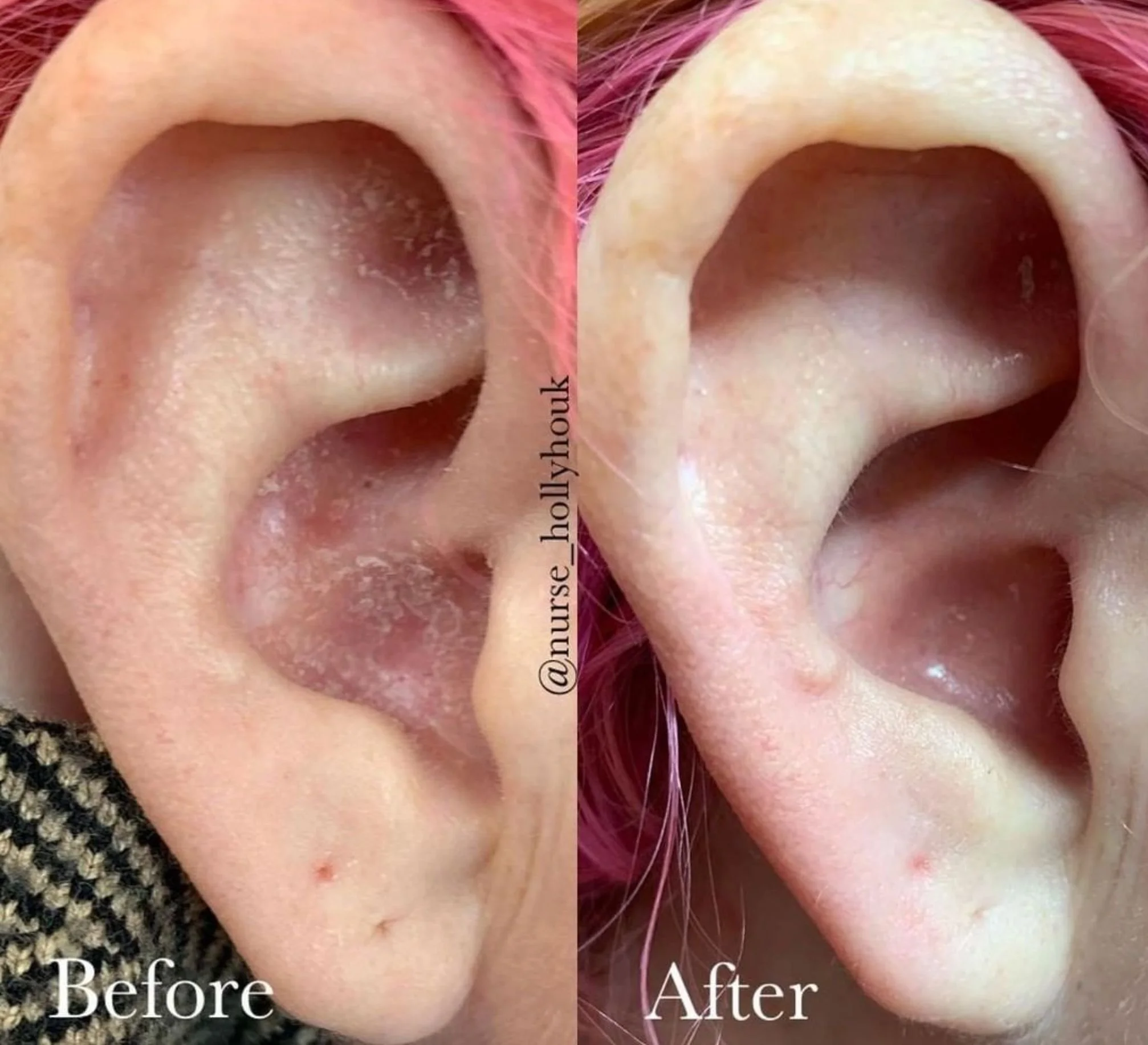  Before and after laser treatment for psoriasis on ear.  