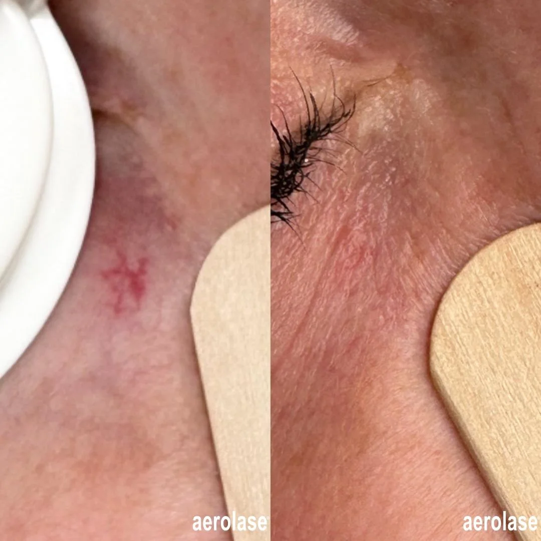  Before and after laser treatment for capillaries on face.  