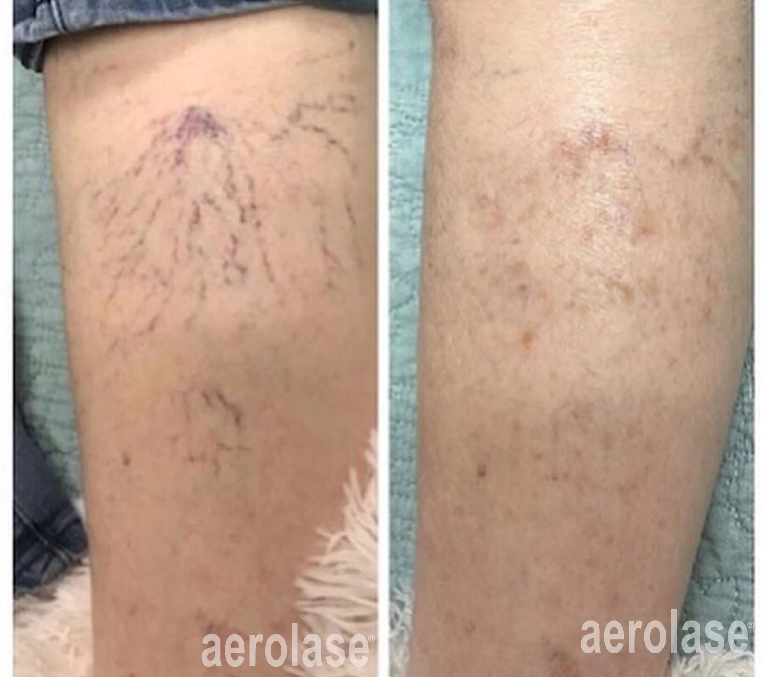  Before and after laser treatment for spider viens.  