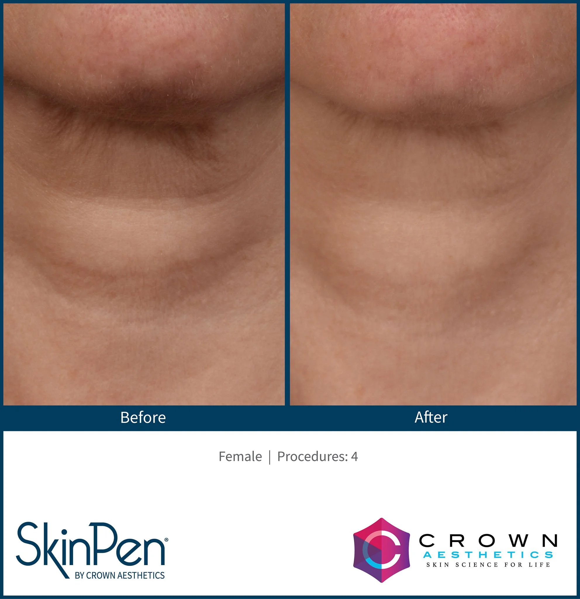  Skinpen microneedling under jaw.  