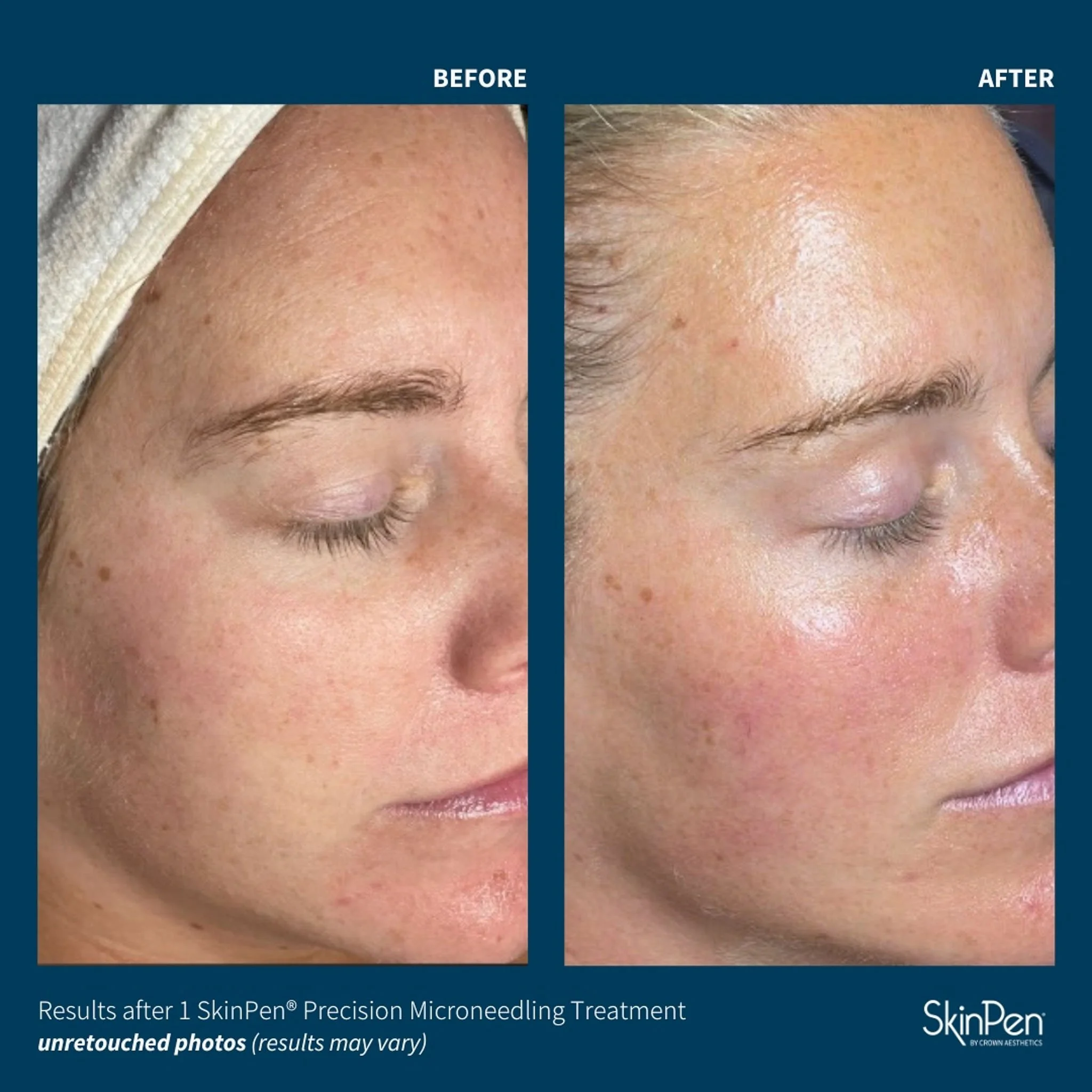  Skinpen microneedling before and after on face. 