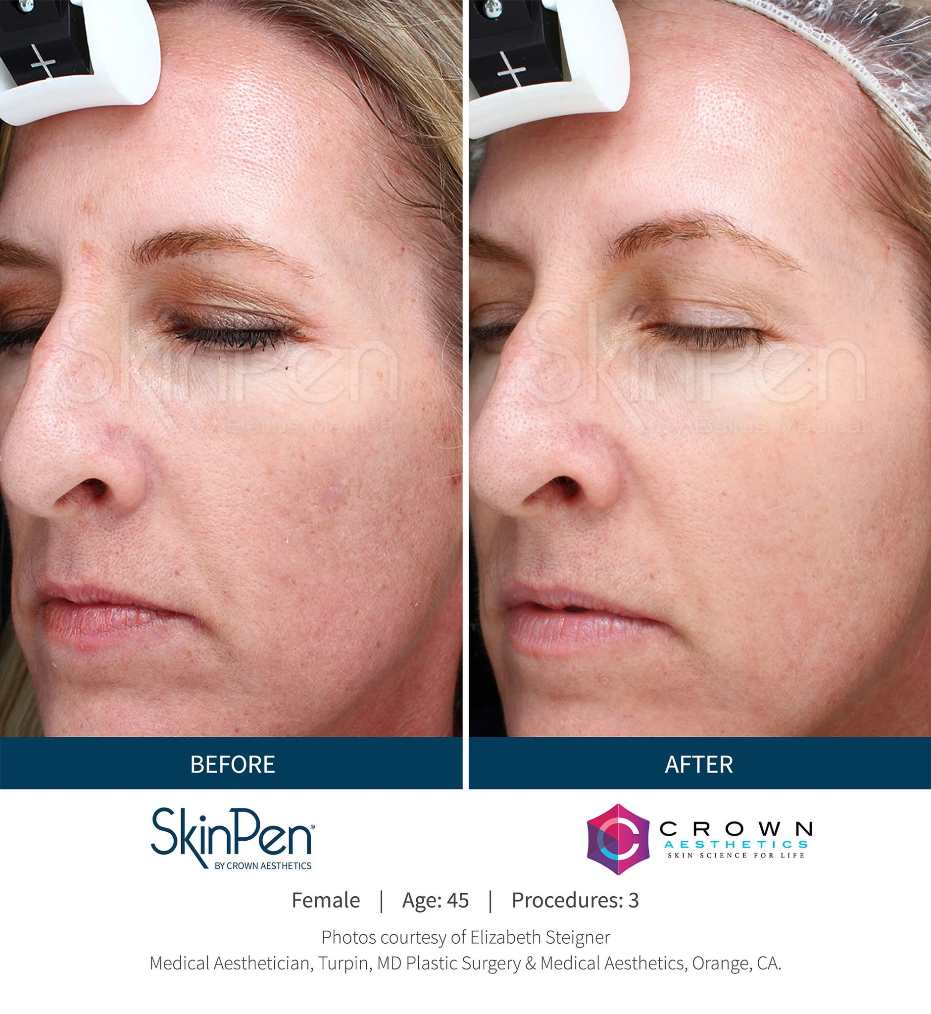  Skinpen microneedling before and after on cheeks. 