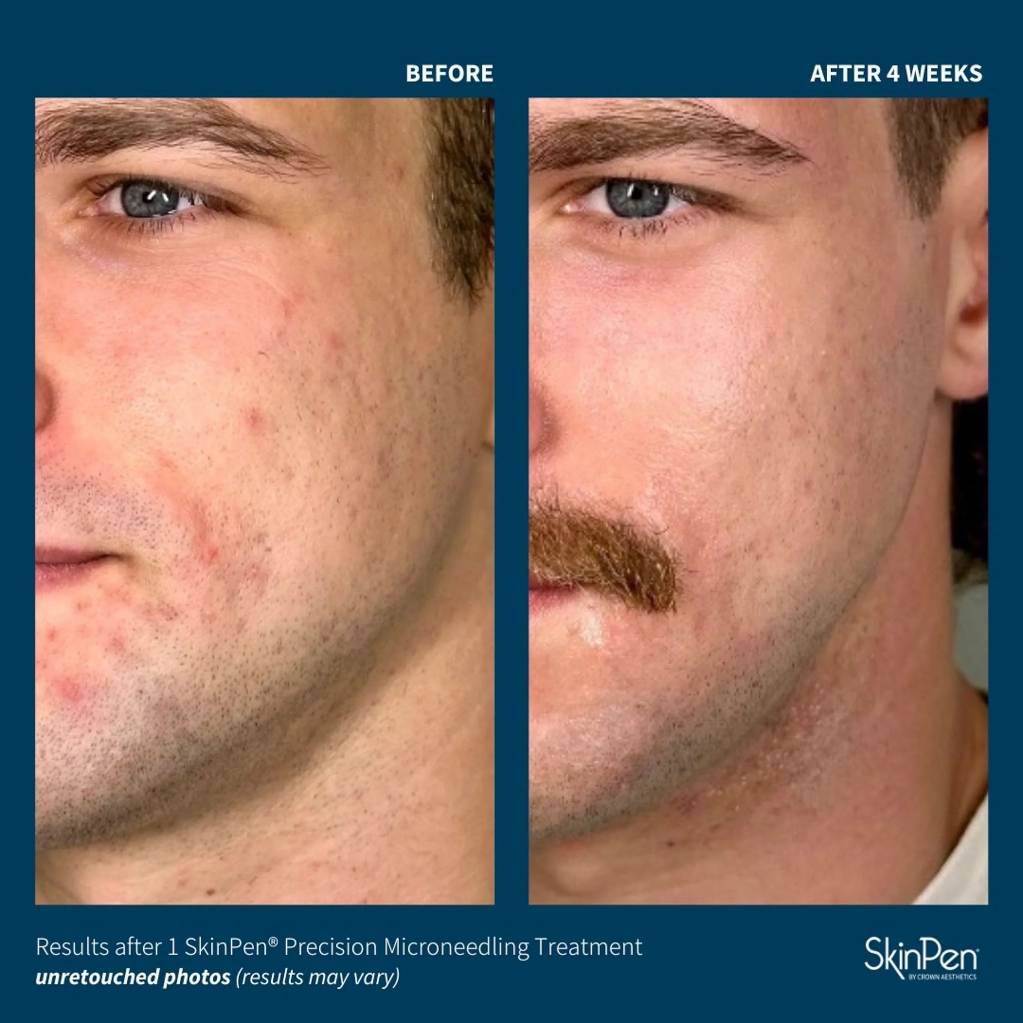  Skinpen microneedling before and after one treatment 