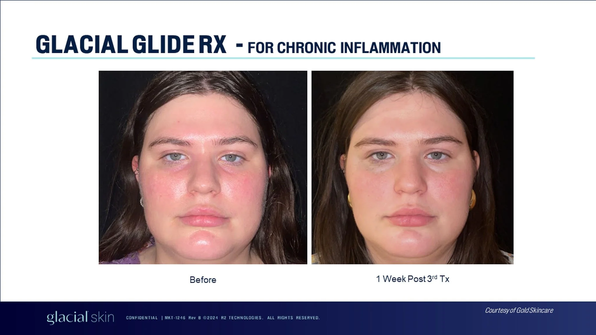  Before and after chronic inflammation facial.  