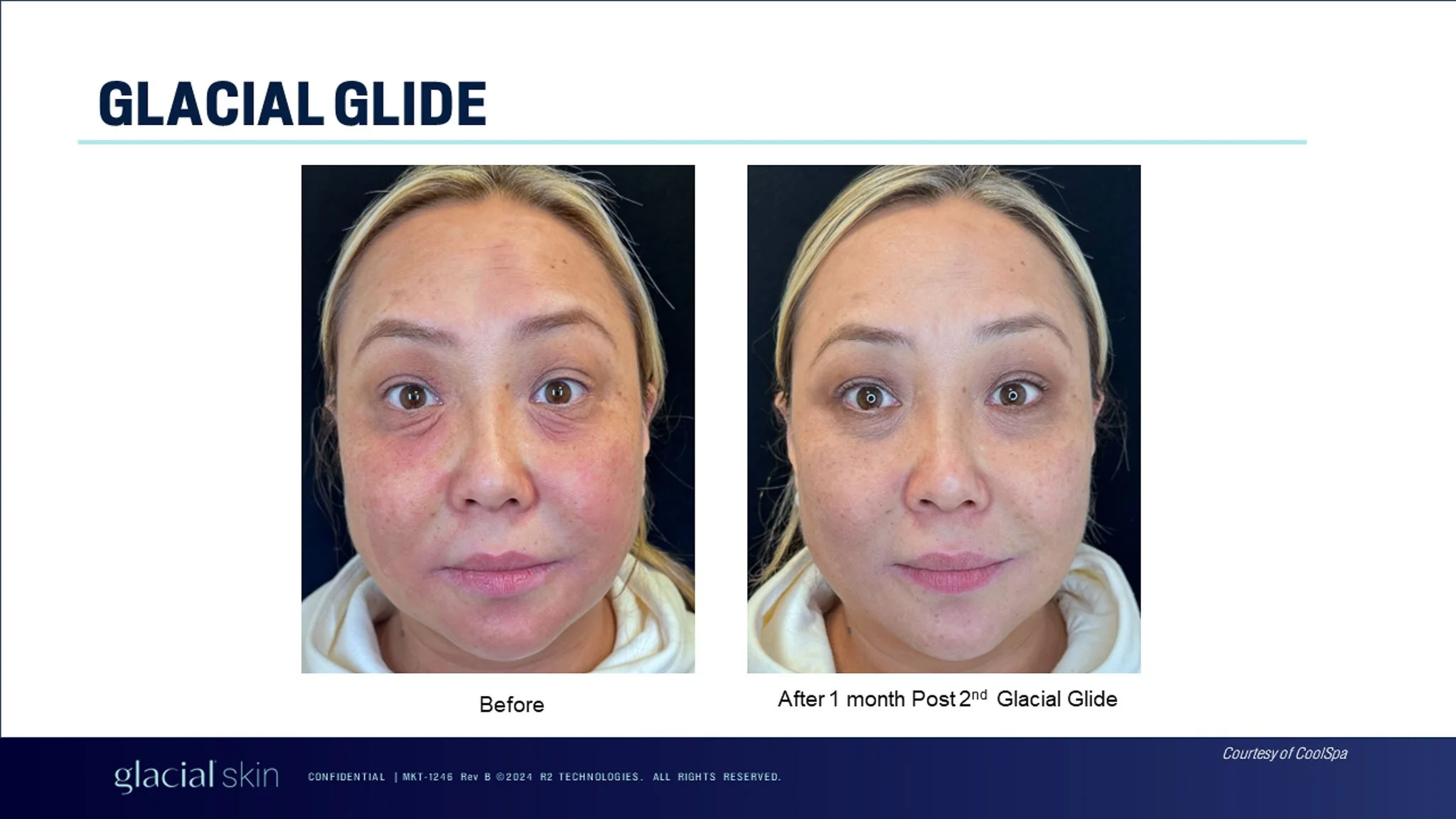  Before and after glacial glide treatment for face. 