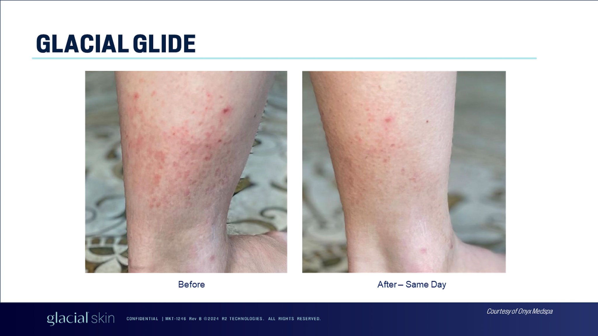  Glacial glide before after to treat legs.  