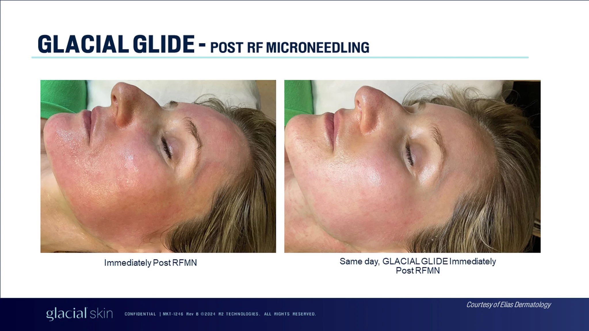  Glacial glide post microneedling.  