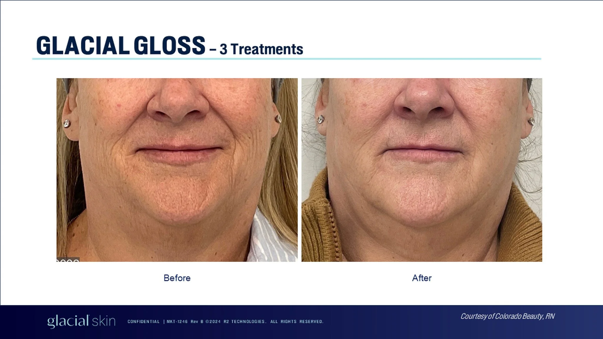 glacial-gloss-before-after-three-treatments.jpg