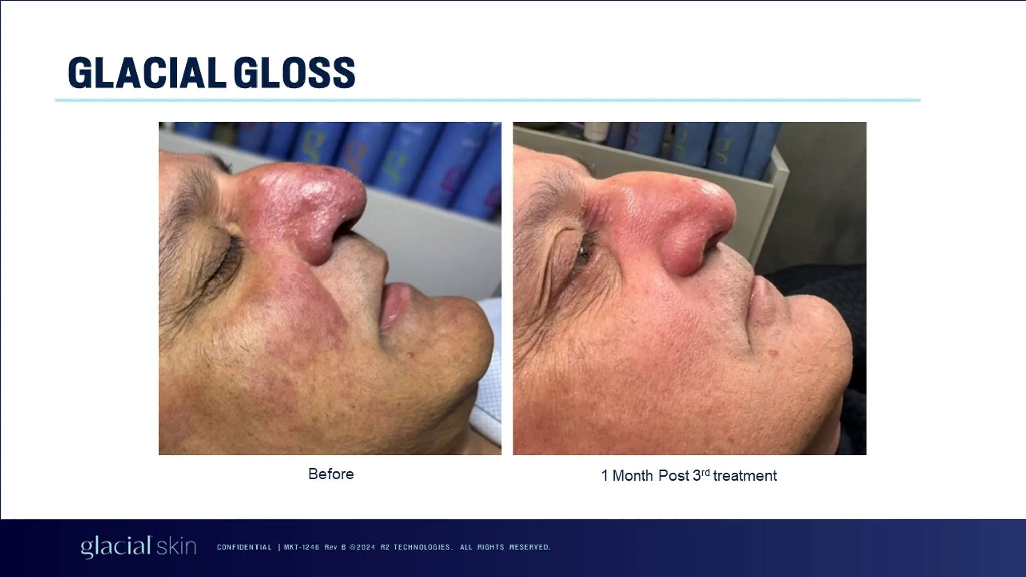 glacial-gloss-before-third-treatment.jpg