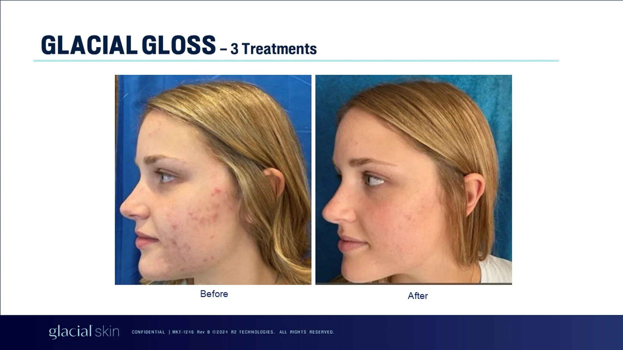glacial-gloss-three-treatments-before-after-facial.jpg