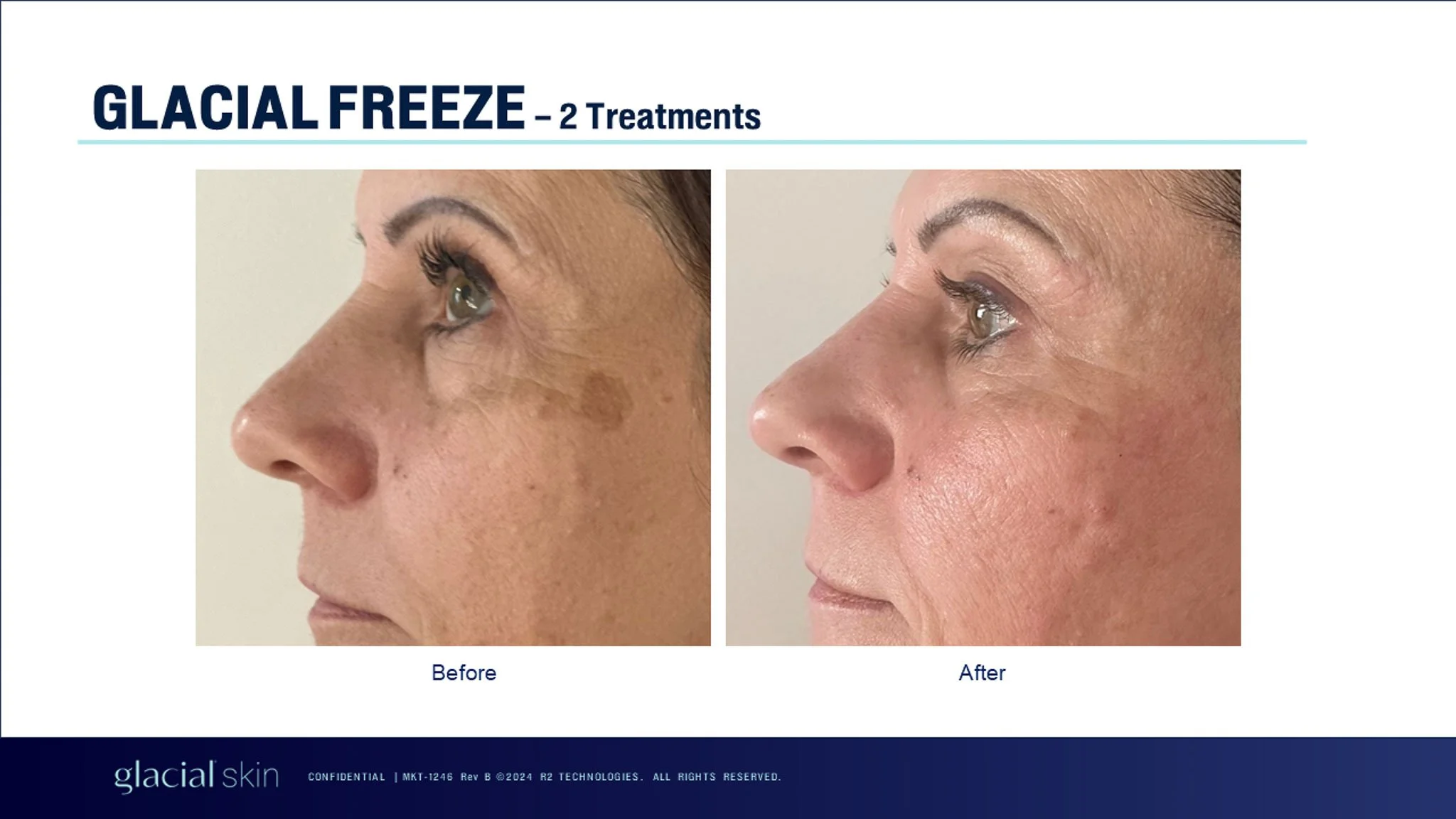  Cryotherapy treatment for skin tags.  