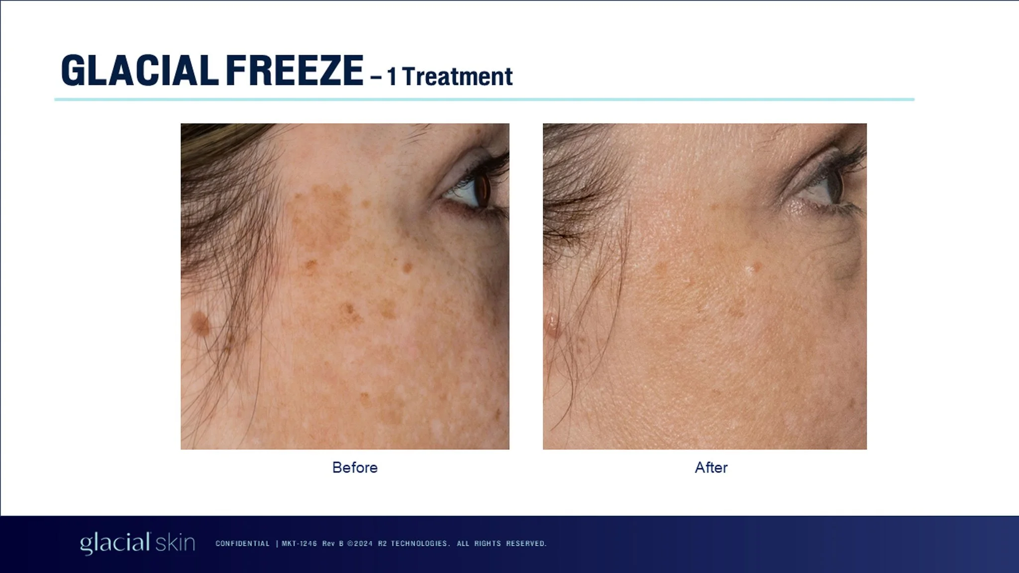  Cryotherapy treatment for aging spots.  