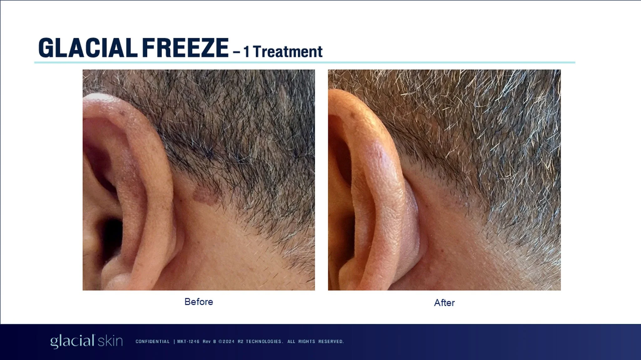  Cryotherapy treatment for aging spots.  