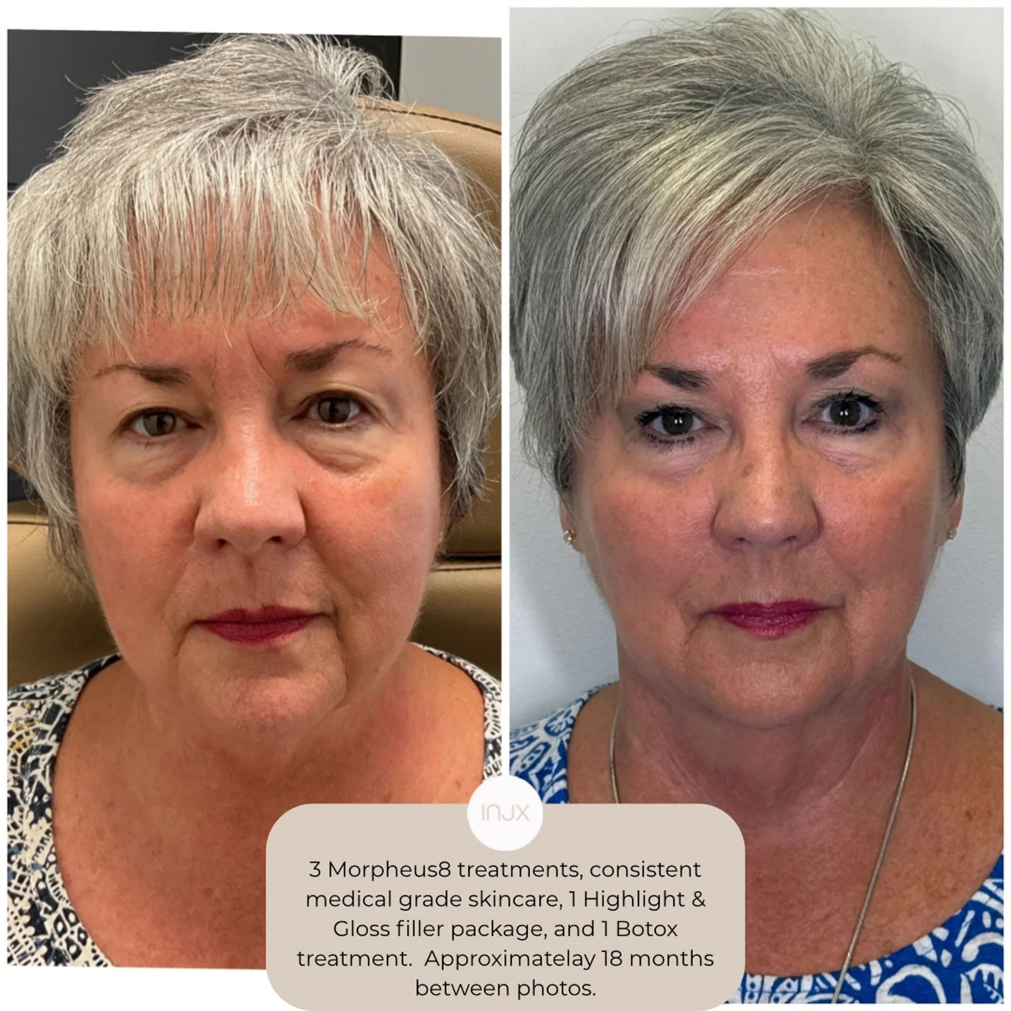  3 Morpheus8 treatments, consistent medical grade skincare, 1 highlight and gloss filler package, and 1 botox treatment.  