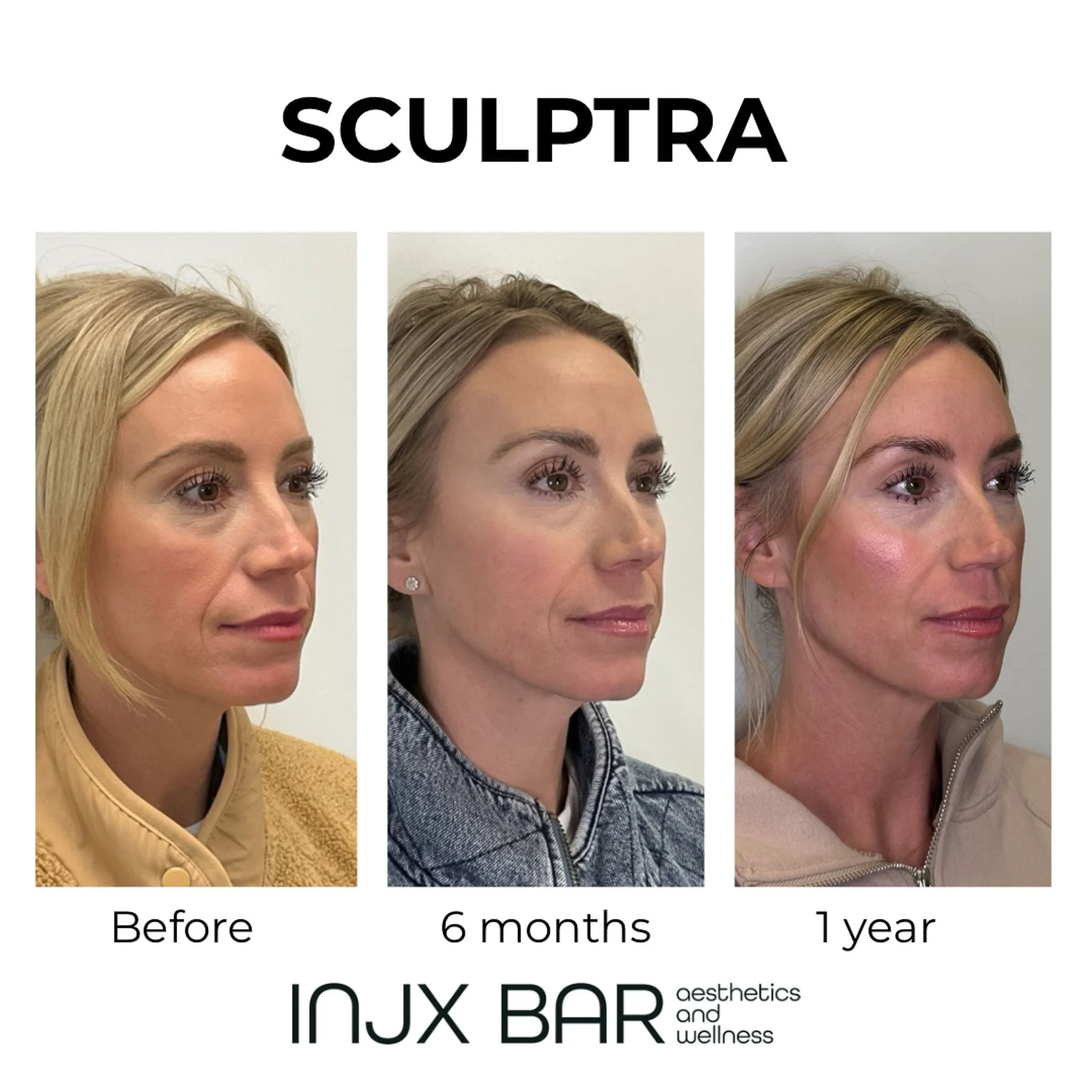 sculptra-1year-sideview.jpg