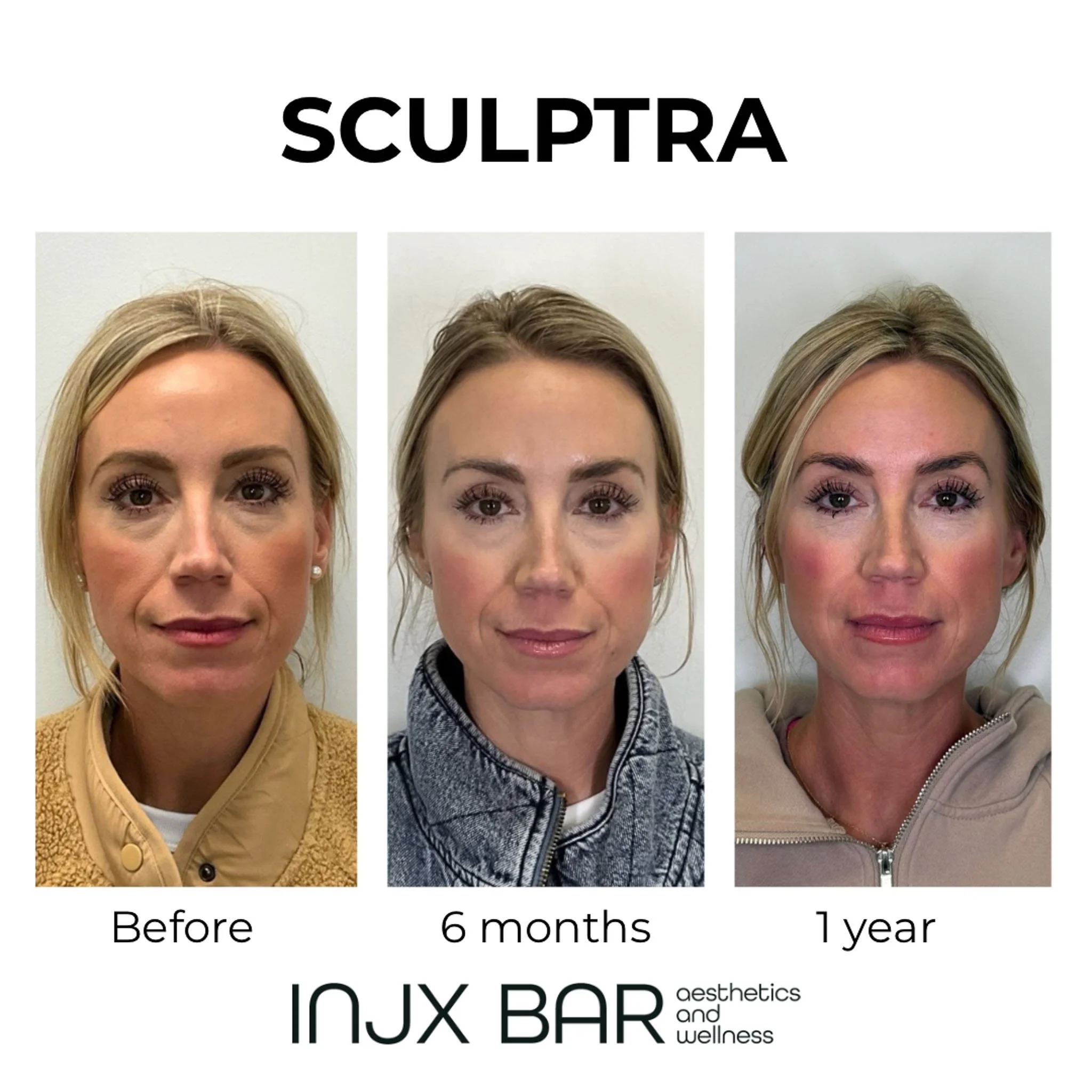 sculptra-6-months.jpg