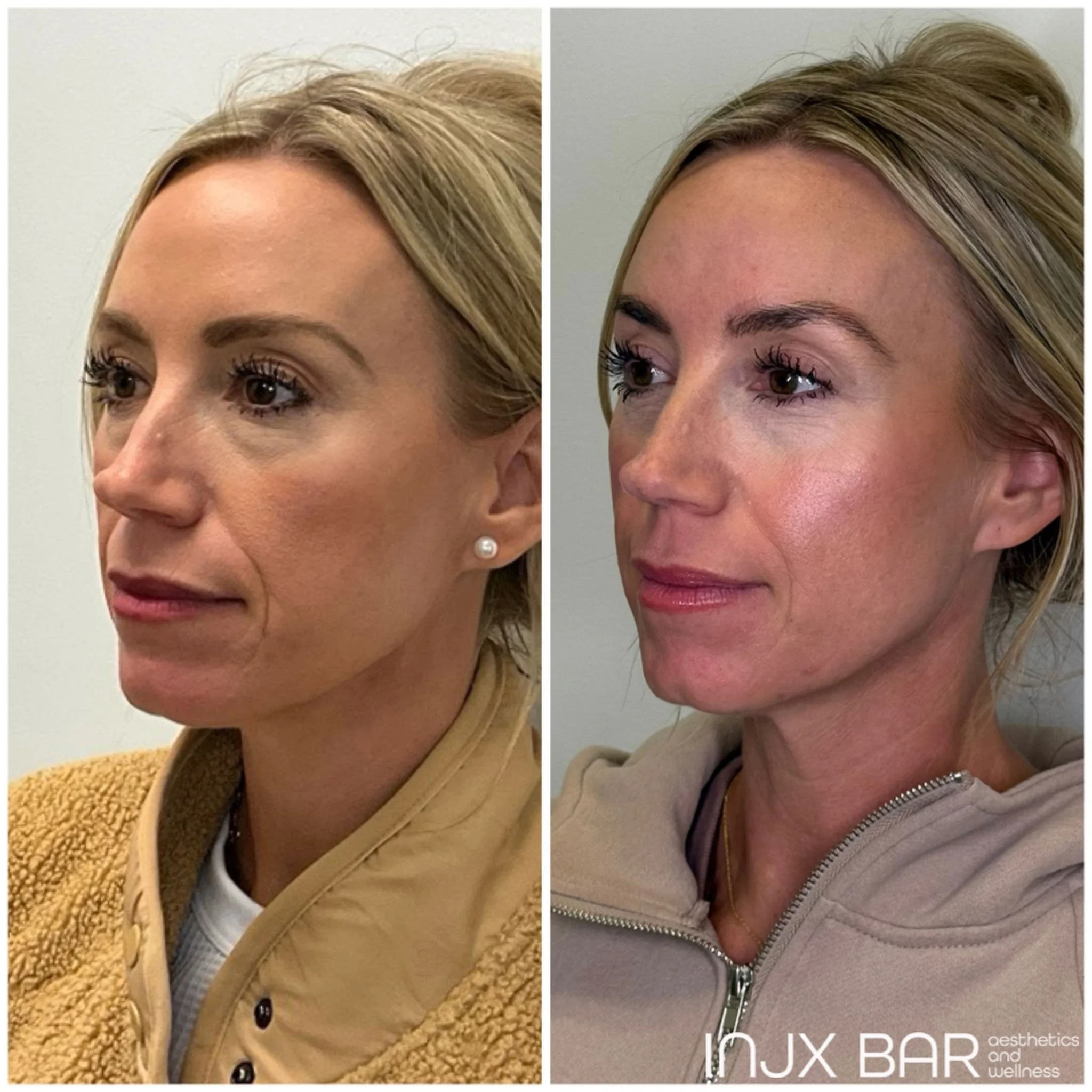 sculptra-left-view-before-after.jpg