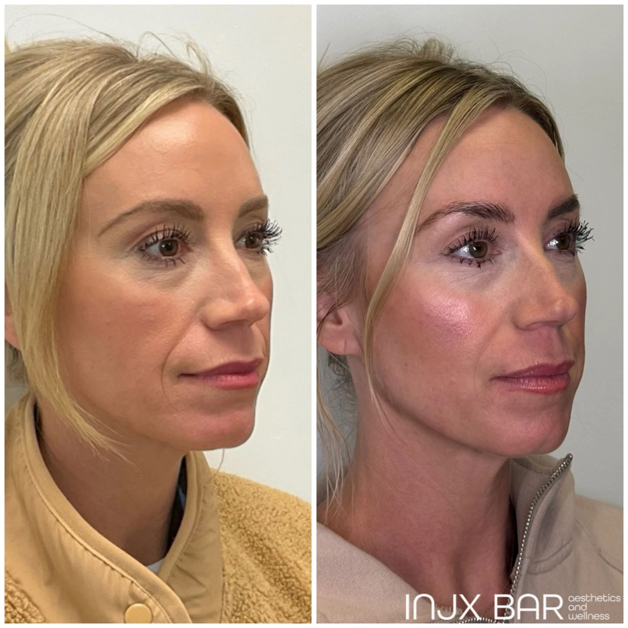 sculptra-right-view-before-after.jpg