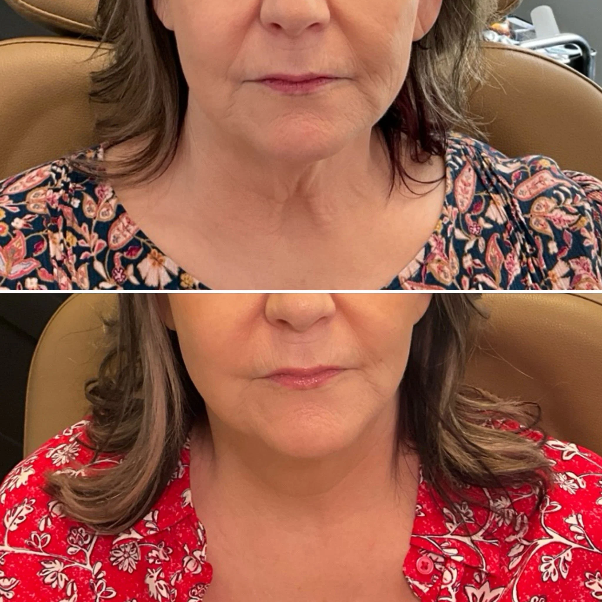 morpheus8-facial-contouring-near-me.jpg