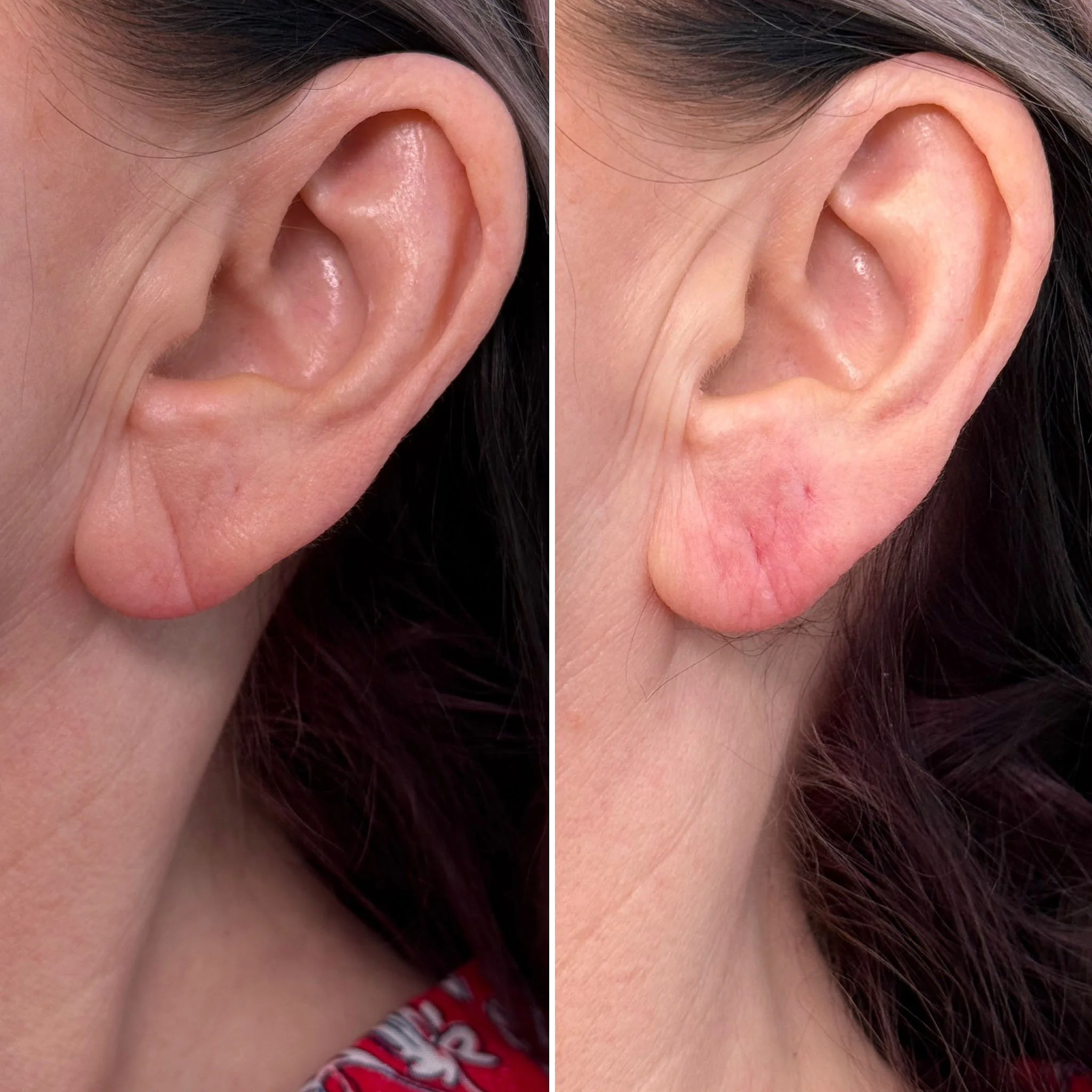 ear-filler-before-after.jpg