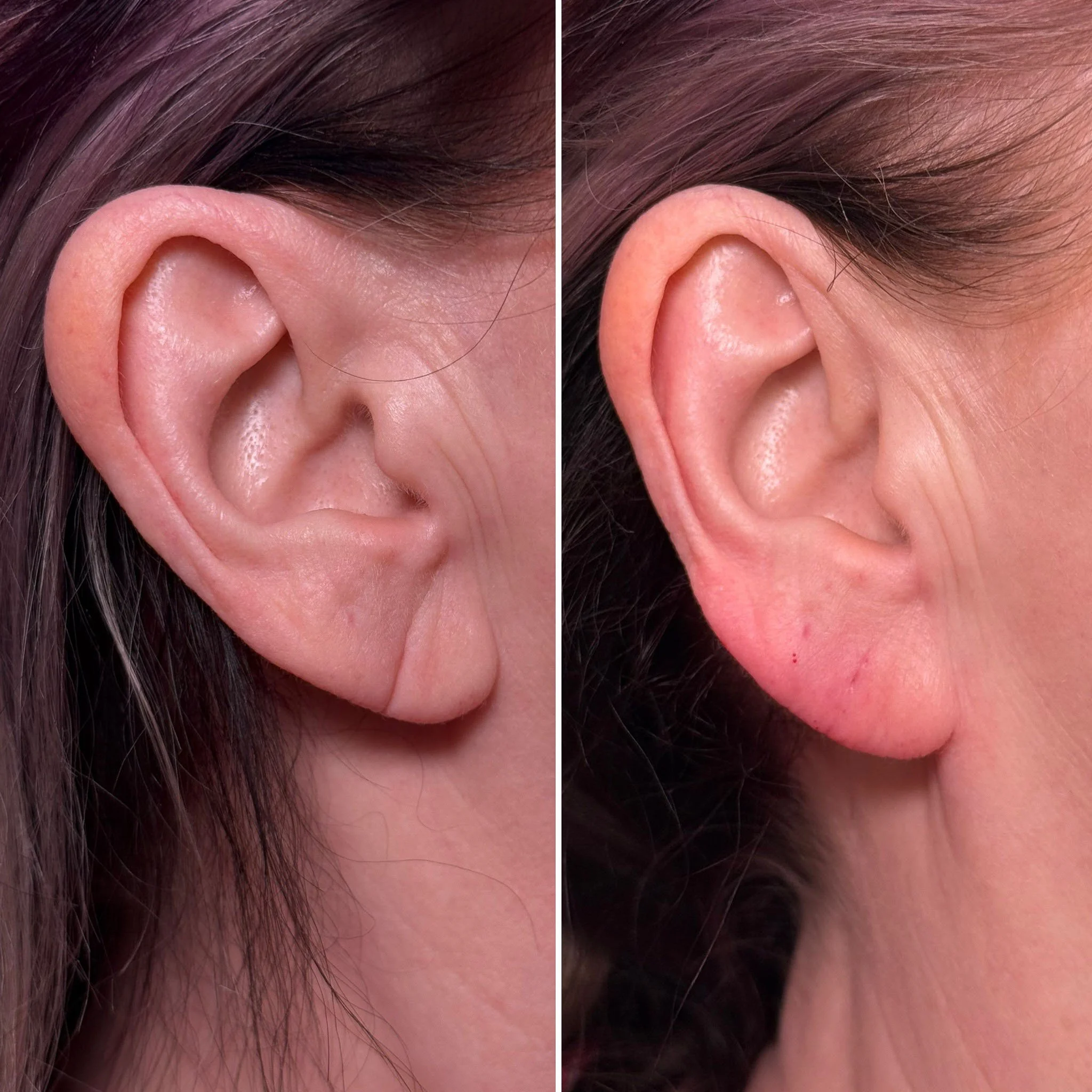 ear-filler-before-after-peoria.jpg