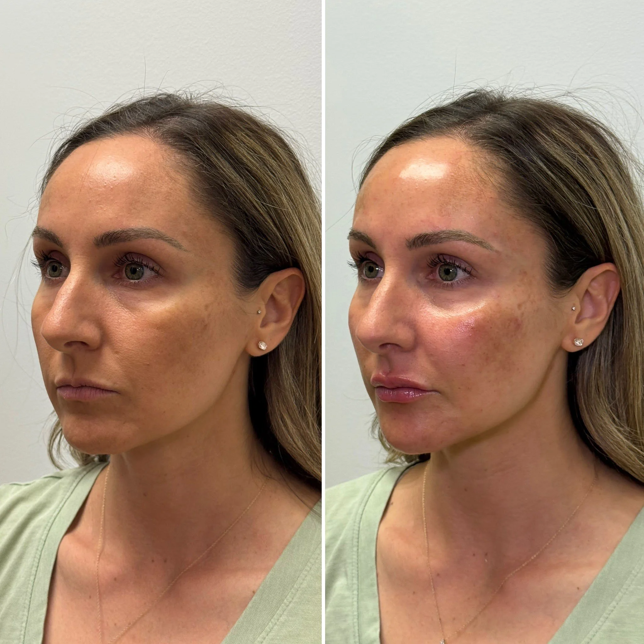 facial-balancing-before-after-north-peoria.jpg