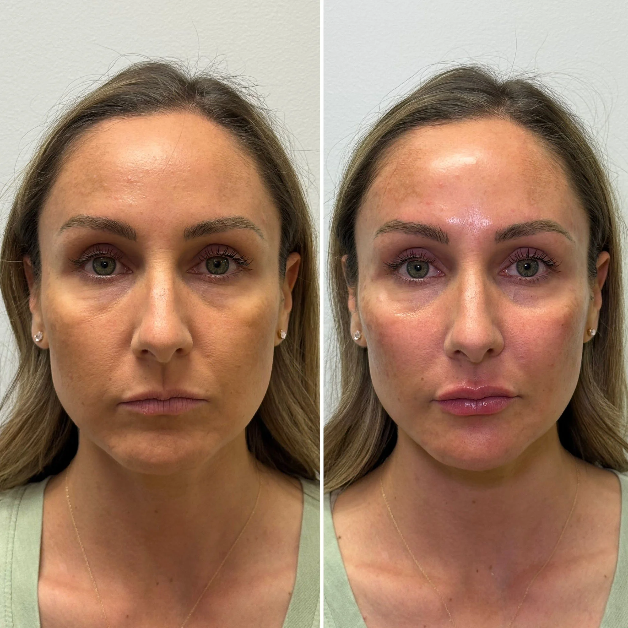 facial-balancing-dermal-filler-before-after.jpg